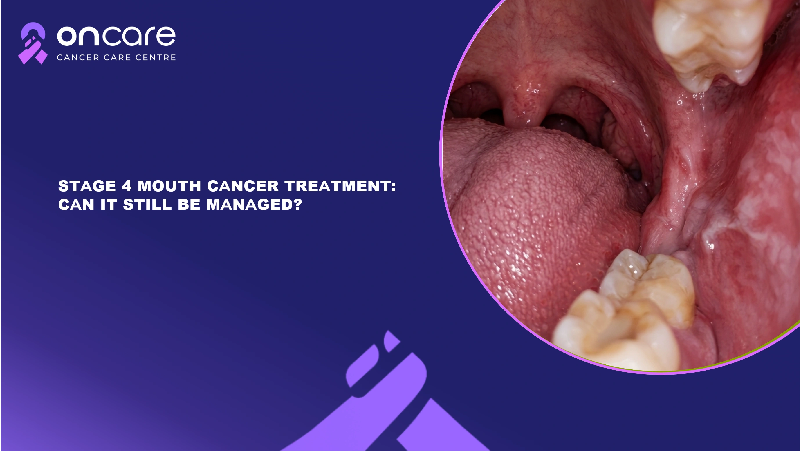 Stage 4 Mouth Cancer Treatment Care Oncare Cancer Hospital
